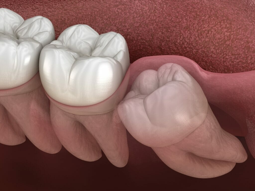 Impacted wisdom teeth Kitchener