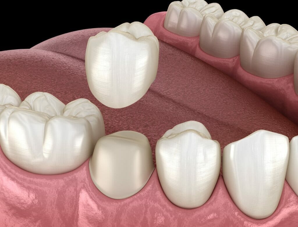 dental crowns near me