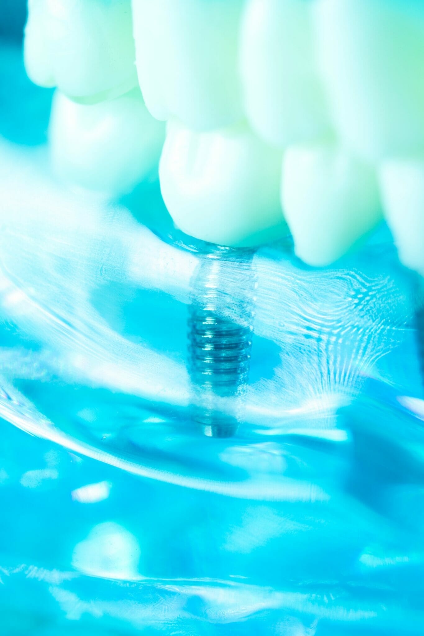 Dental Implants Things You Should Know Kitchener Dentist Kyle Hornby