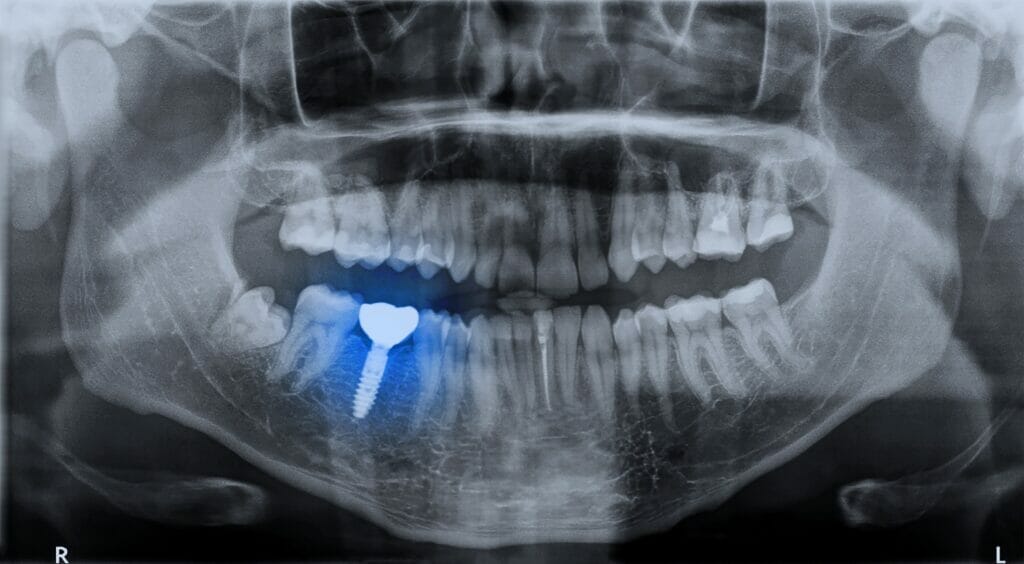 dental implants kitchener