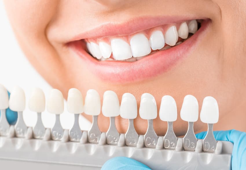 Teeth Whitening: 5 Important Things to Know Before You Start!