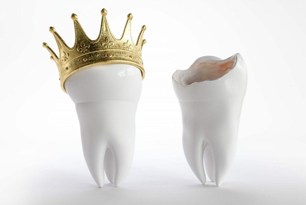 What Is Crown Lengthening And How Much Does It Cost Enamel Republic