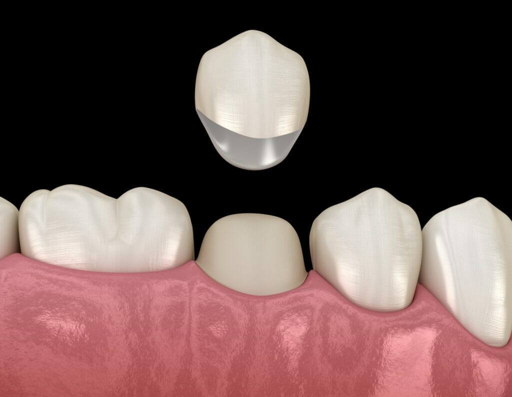 dental crowns in kitchener