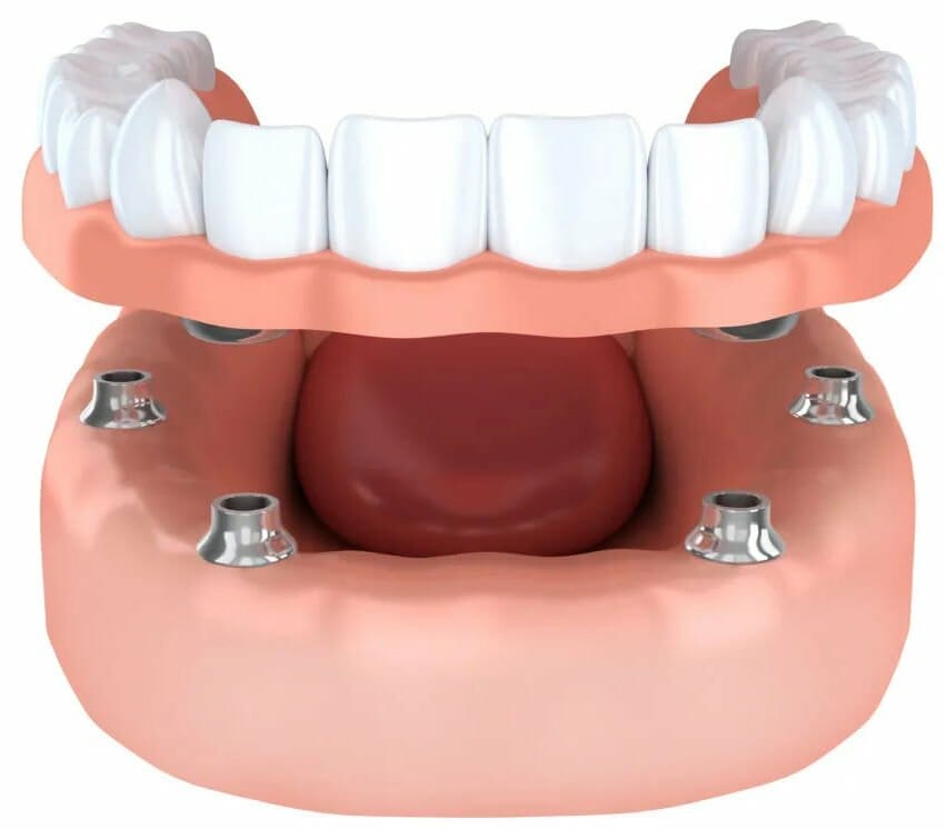 Implant dentures