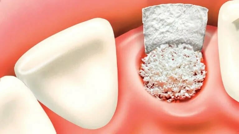 Bone Grafting for Dental Implants