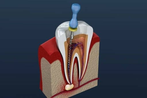 root canal treatment