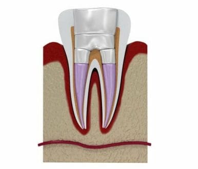 root canal treatment kitchener