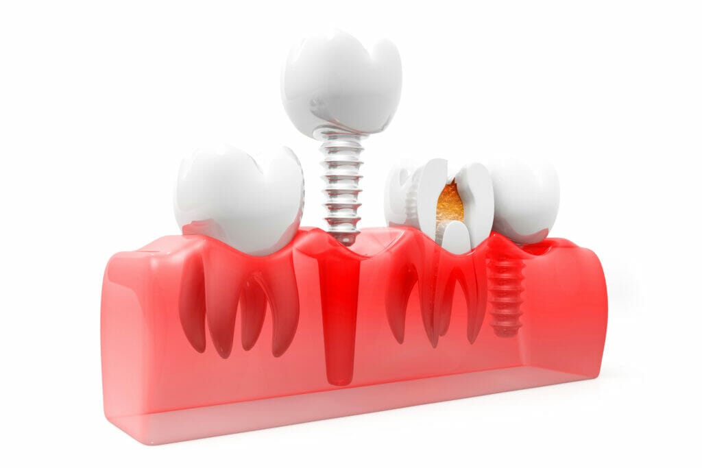 root canal or extraction