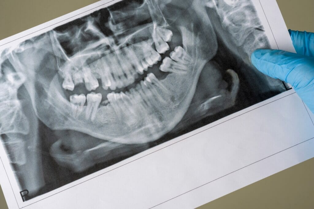 can dental bone loss be reversed