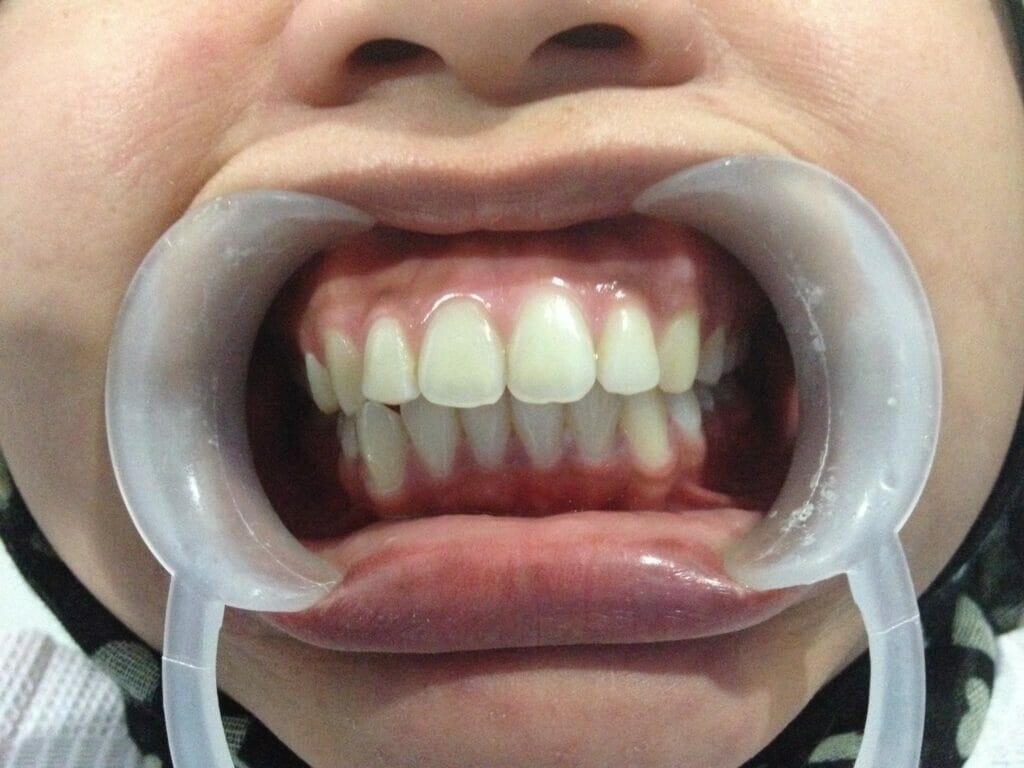 gum recession