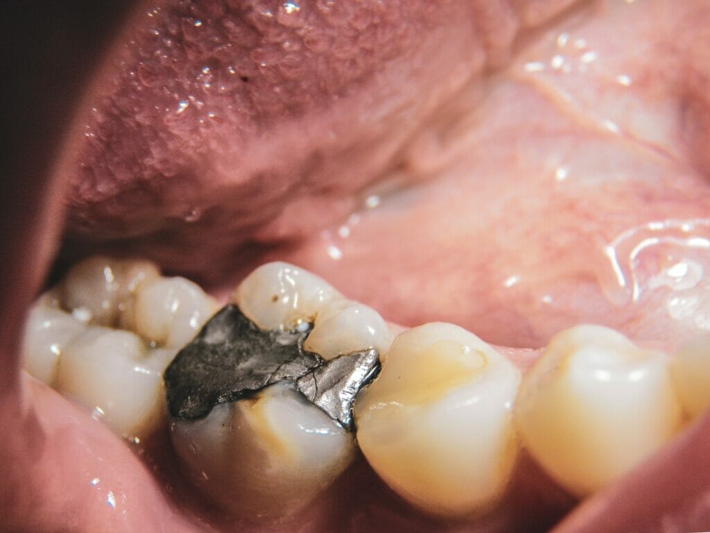 amalgam filling